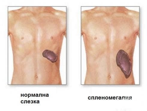 Спленомегалия, некласифицирана другаде МКБ R16.1 - изображение