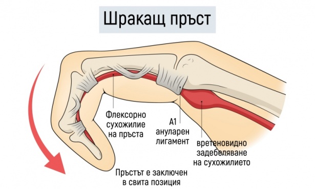 Щракащ пръст МКБ M65.3 - изображение
