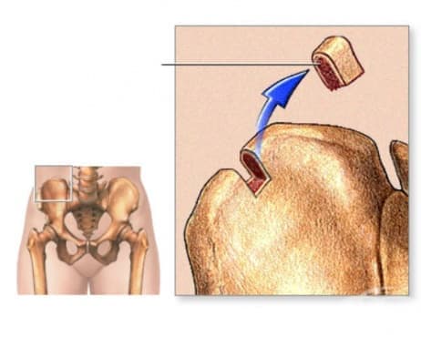 Костный мозг подвздошной кости. Биопсия костного мозга бедренной кости. Трепан биопсия подвздошной кости. Взятие трансплантата из подвздошной кости.