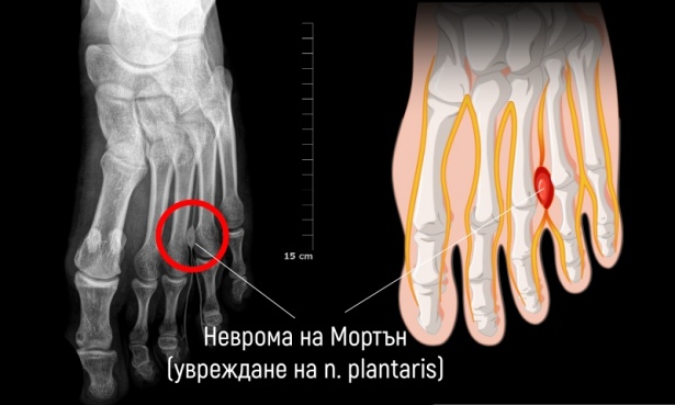 Увреждане на n. plantaris МКБ G57.6 - изображение