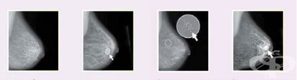 Клинична патология при доброкачествени тумори на гърдата - изображение