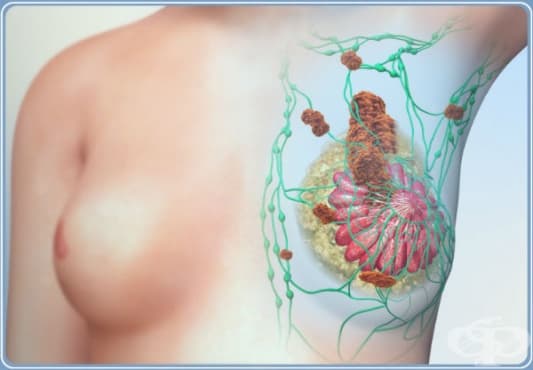 Клинична патология на гърдата - изображение