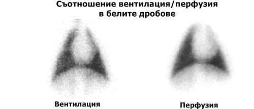 Промени в отношението вентилация/перфузия - изображение