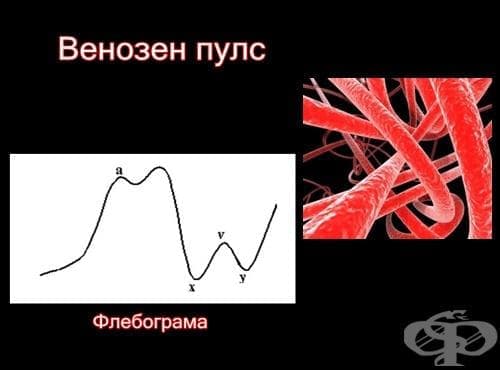 Венозен пулс - изображение