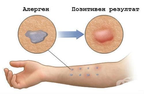 Диагностициране на алергия