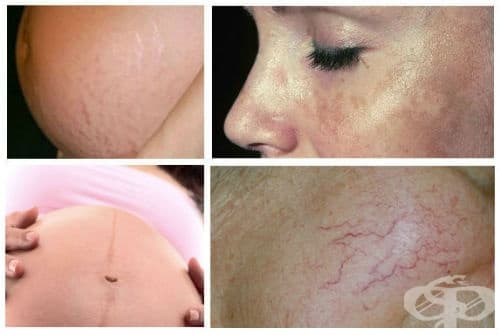 Кожни промени по време на бременността