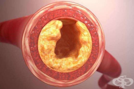 Атеросклероза