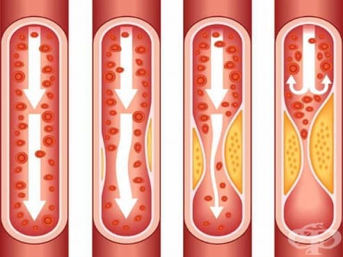 Атеросклероза