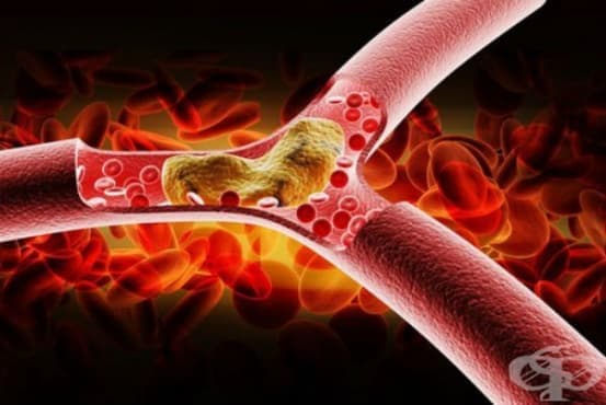 Атеросклероза