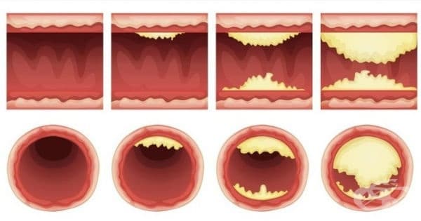 Атеросклероза