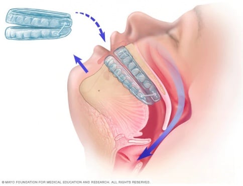 Импланти при сънна апнея