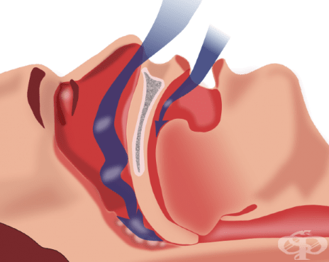 Сънна апнея