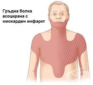 Локализация на болката при миокарден инфаркт