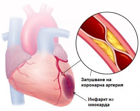 Миокарден инфаркт
