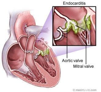 Инфекциозен ендокардит