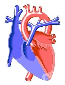 Вродени сърдечни малформации