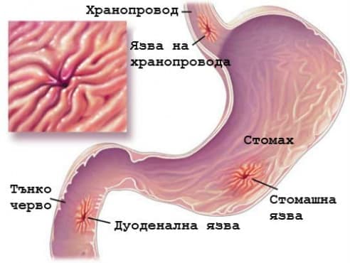 Пептични язви