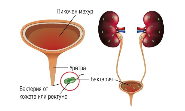 Усложнения при цистит