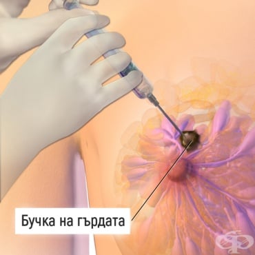 Биопсия