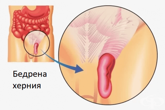 Бедрена херания