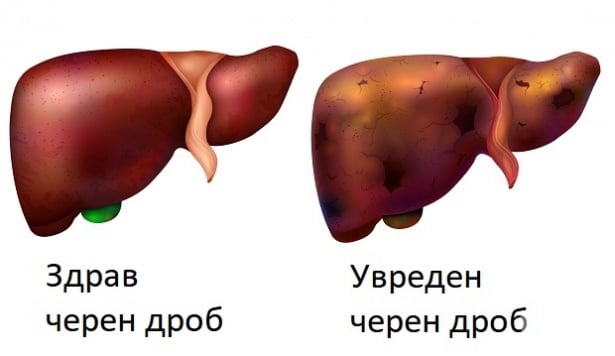 Увреден черен дроб следствие от хепатит