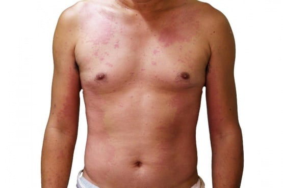 Алергичен обрив от лекарства