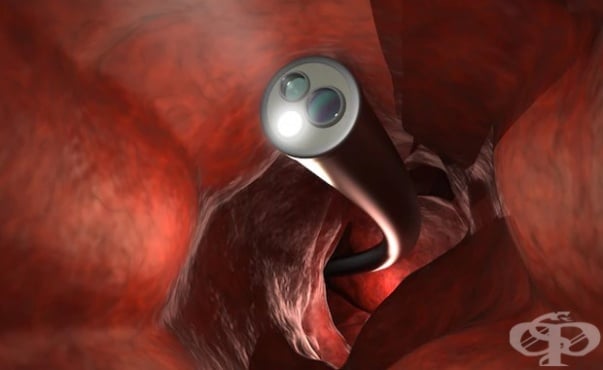 Колоноскопия