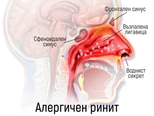 Алергичен ринит