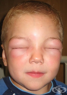 Подуване на лицето при тежка алергия