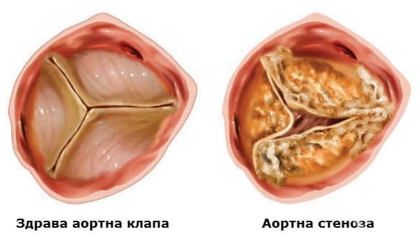 Аортна стеноза