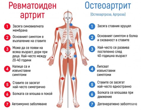 Разлика между ревматоиден артрит и остеоартрит