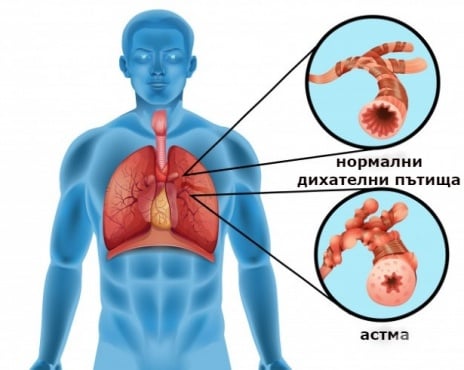 Астма: обструкция на дихателните пътища