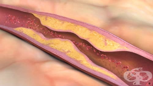 Атеросклероза