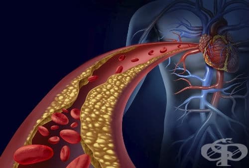 Атеросклероза