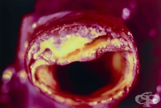 Атеросклероза