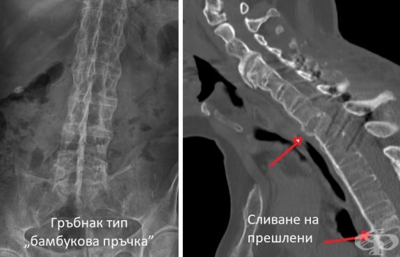 Гръбнак тип "Бамбукова пръчка" и сливане на прешлени