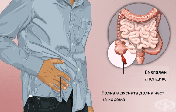 Болка при апендицит