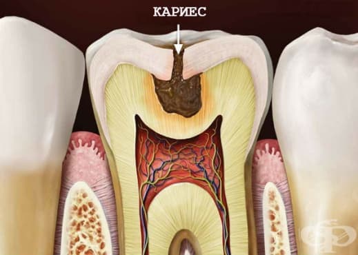 Кариес