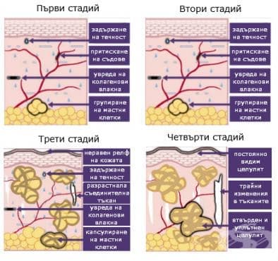 Стадии на целулит