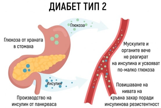 Диабет тип 2