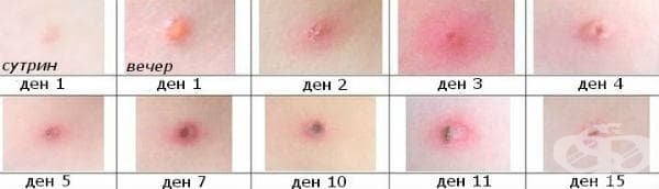 Еволюция на обрива при варицела
