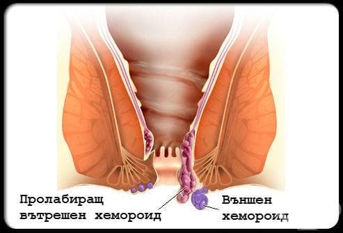 Външен хемороид