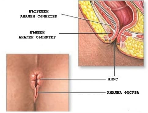 Анална фисура