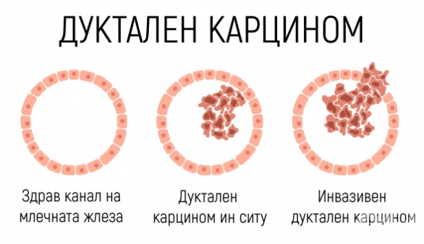 Дуктален карцином