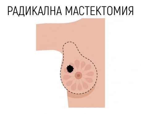 Мастектомия