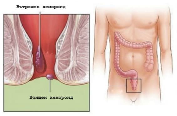 Вътрешни и външни хемороиди