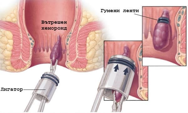 Банд лигиране