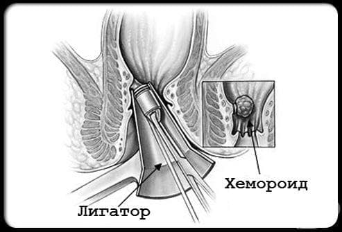 Банд лигиране