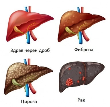 Фиброза, цироза, рак след хепатит