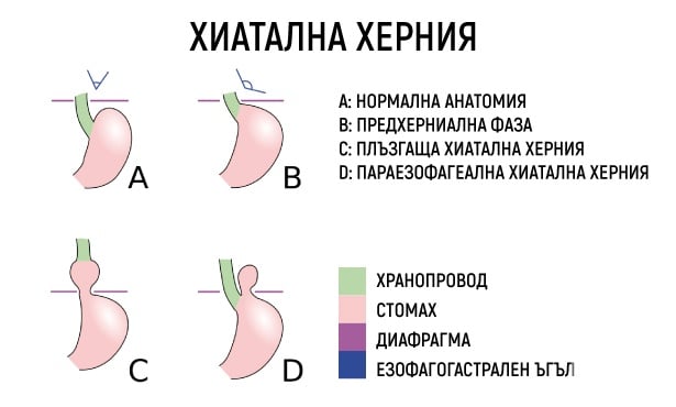 Видове хиатална херния